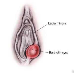 LET’S TALK ABOUT: HERBAL RELIEF FOR BARTHOLIN CYSTS from PixiesPocket.com