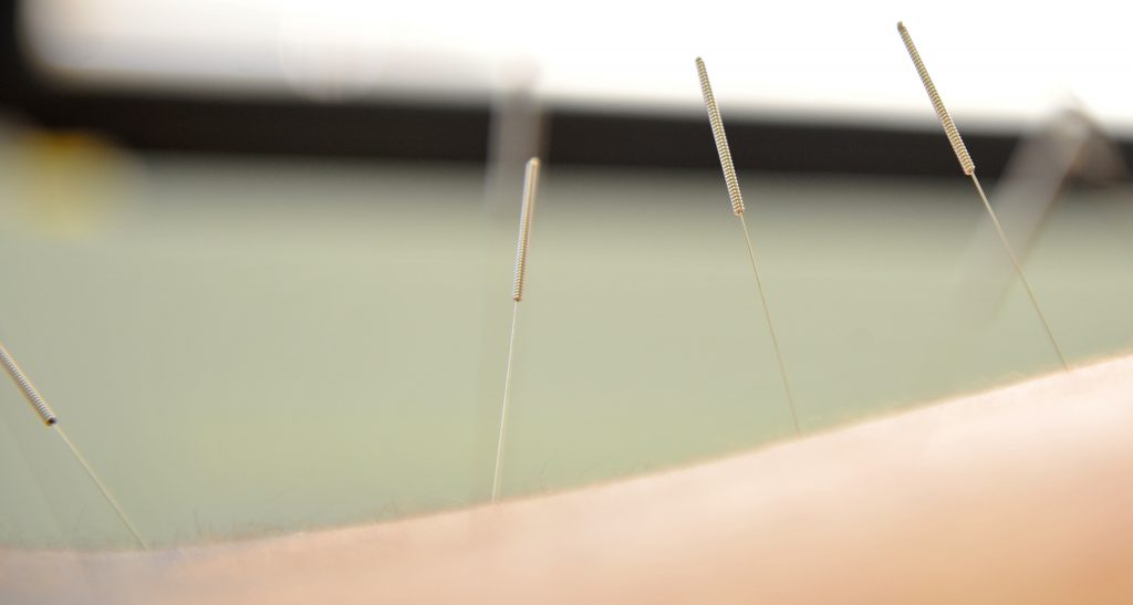 Acupuncture